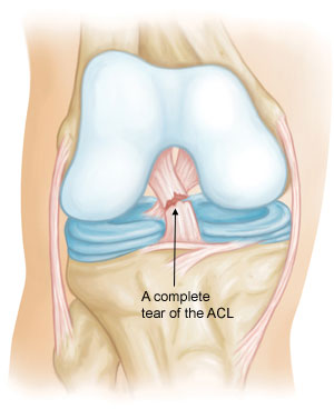 ACL Tear requiring ACL Reconstruction