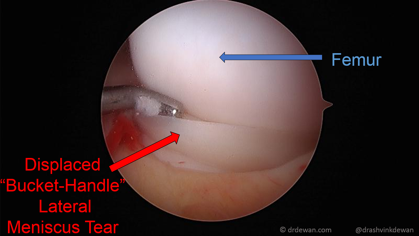 Pre-operative MRI showing the displaced bucket-handle lateral meniscus tear