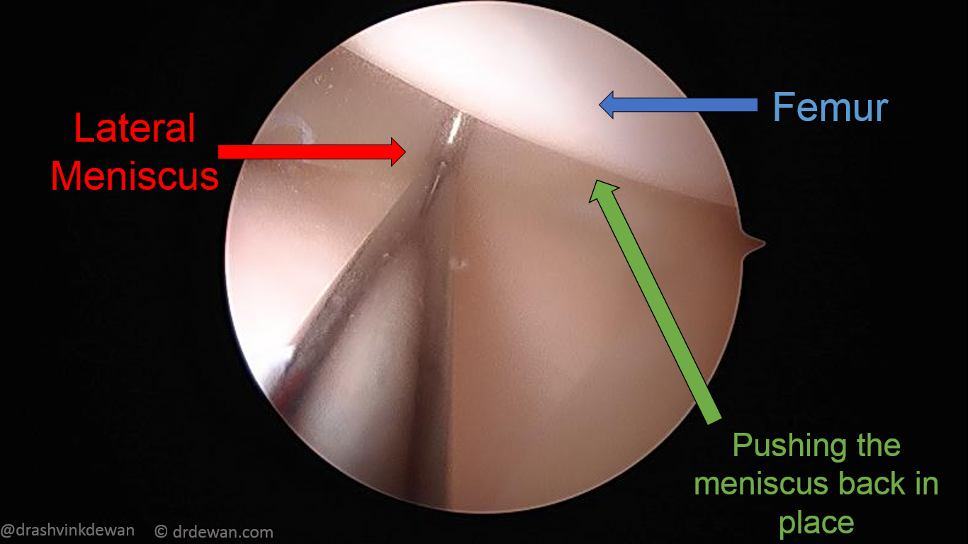 Arthroscopic view of the displaced meniscus inside the joint