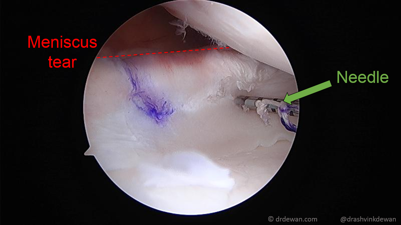 Reduction of the bucket-handle tear back to its anatomic position on the tibial plateau