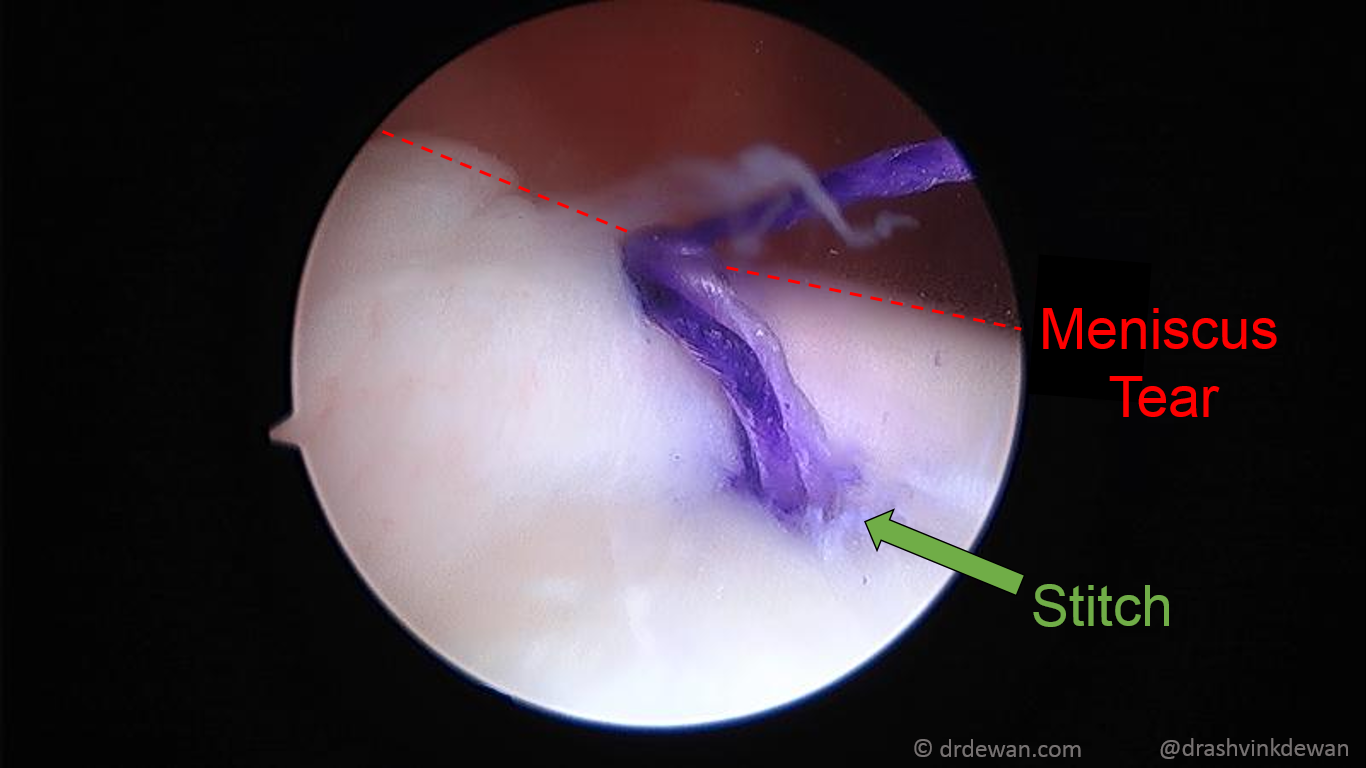 All-inside meniscus repair sutures placed across the tear