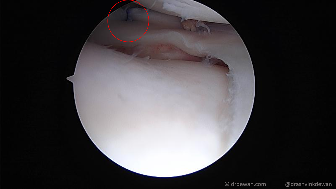 Final view of the repaired bucket-handle meniscus — anatomically reduced and stable