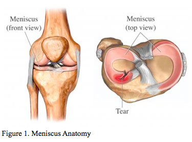 Different patterns of meniscus tears: longitudinal, radial, horizontal, bucket-handle, and complex degenerative