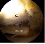Arthroscopic photograph inside a knee showing the detached posterior root of the medial meniscus, labeled MMPR, with an arrowhead marking damaged cartilage on the medial femoral condyle