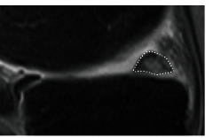 Sagittal MRI of a knee in which the body of the medial meniscus is outlined by a dotted line, showing the ghost sign of a posterior root tear