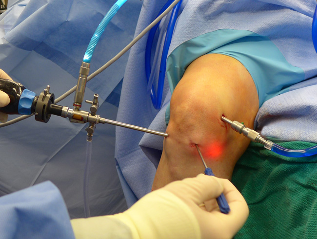 Knee Arthroscopy (picture courtesy of http://orthoinfo.aaos.org/)