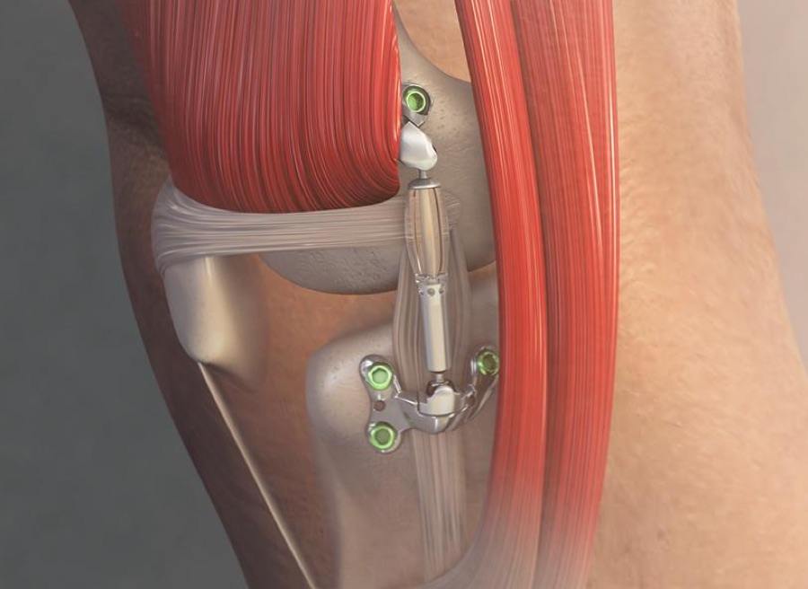 The MISHA Knee System — a small shock absorber implanted outside the knee joint, anchored to the femur and tibia by titanium plates