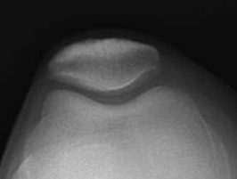 Kneecap Xray