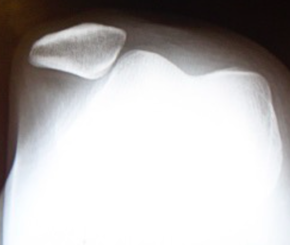 Sunrise-view X-ray of a knee showing the kneecap displaced off the outer edge of its groove