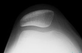 X-ray showing a shallow, flattened trochlear groove at the end of the femur instead of a well-formed V shape