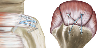 rotator cuff repair anchors