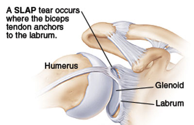 Labral Tear