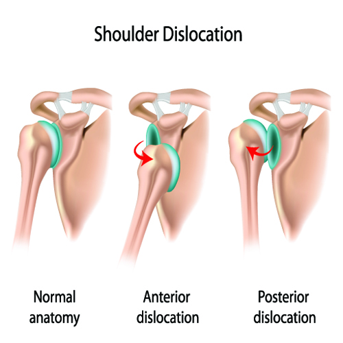 Shoulder Dislocation