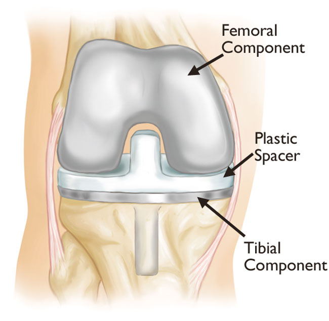 Total knee replacement prosthesis components — femoral and tibial implants